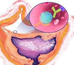 PCSK9 Inhibitors: For Whom, When, and Why