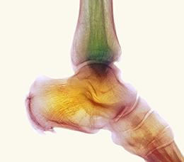 Novel Treatment Modalities for Avascular Necrosis