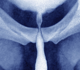 <em>Decision-IQ</em>: How Well Are You Managing Urethral Stricture Disease in Your Patients?