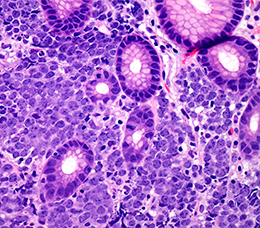 Therapeutic Advances in Relapsed/Refractory DLBCL: A Focus on Newly Available Treatment Strategies