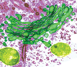 Fabry Disease: When to Treat