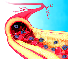 Recognizing Residual Inflammatory Risk and Preventing Recurrent Events in Patients With Atherosclerotic Cardiovascular Disease