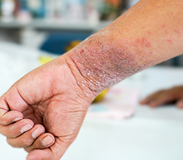 Helping Your Patients With Timely Diagnosis, Management, and Specialist Referrals for Moderate-to-Severe Atopic Dermatitis